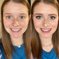 Dreifarbige Concealer-Palette zum Abdecken von Aknenarben und Augenringen✨Kaufen Sie 3 und erhalten Sie 2 gratis